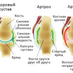 Arthritis and arthrosis